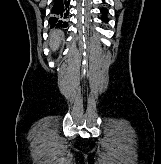 File:Acute appendicitis (Radiopaedia 79950-93224 Coronal C+ portal venous phase 85).jpg