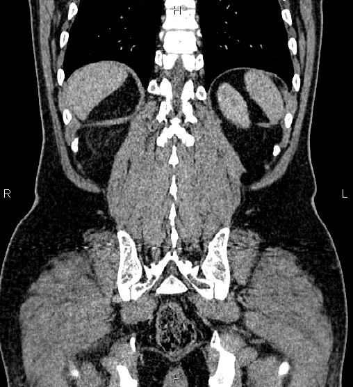 Acute appendicitis (Radiopaedia 84780-100240 Coronal C+ portal venous phase 68).jpg
