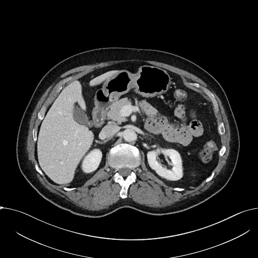 Acute appendicitis - large appendicoliths (Radiopaedia 61805-69820 Axial C+ portal venous phase 42).jpg
