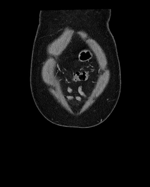 Acute appendicitis - large appendicoliths (Radiopaedia 61805-69820 Coronal C+ portal venous phase 16).jpg