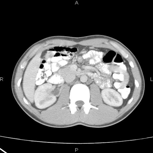 File:Acute appendicitis with CT arrowhead sign (Radiopaedia 21474-21411 Axial C+ portal venous phase 15).jpg