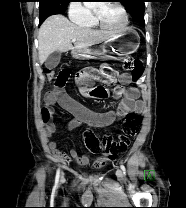 Acute arterial mesenteric ischemia (Radiopaedia 78238-90828 Coronal C+ portal venous phase 36).jpg