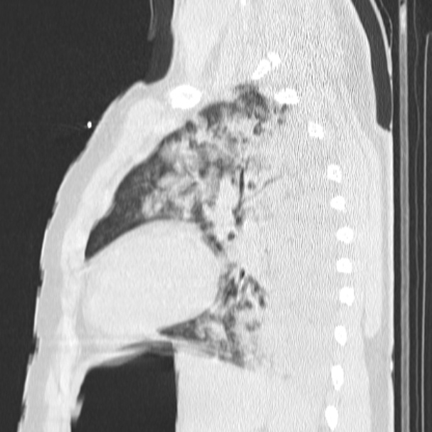 Acute aspiration pneumonitis (Radiopaedia 33605-34703 Sagittal lung window 60).jpg