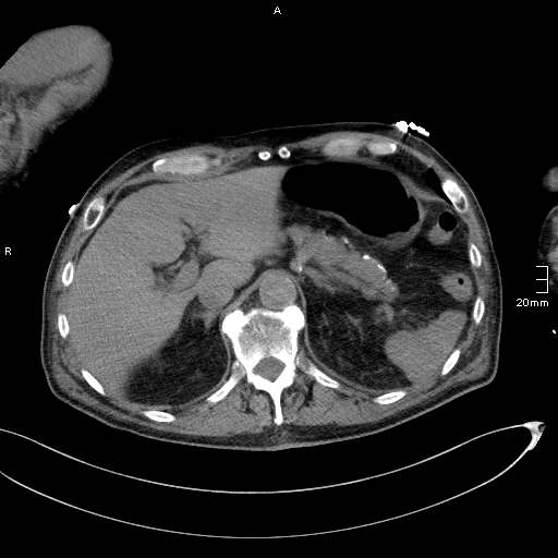 Acute aspiration pneumonitis (Radiopaedia 55642-62166 Axial liver window 60).jpg