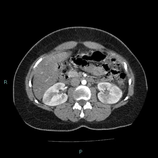 File:Acute bilateral pyelonephritis (Radiopaedia 37146-38881 Axial C+ arterial phase 82).jpg