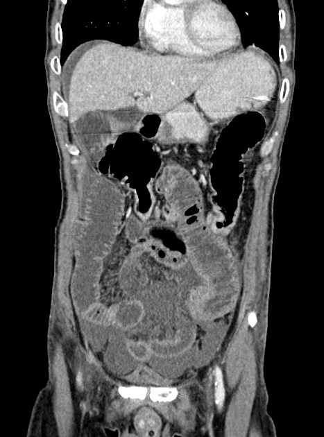 Acute bowel ischemia (Radiopaedia 87695-104114 Coronal C+ portal venous phase 136).jpg