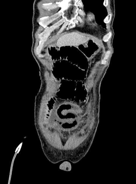 Acute bowel ischemia (Radiopaedia 87695-104114 Coronal C+ portal venous phase 88).jpg