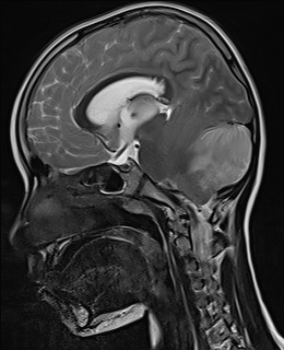 File:Acute cerebellar ataxia (Radiopaedia 61487-69446 Sagittal T2 7).jpg