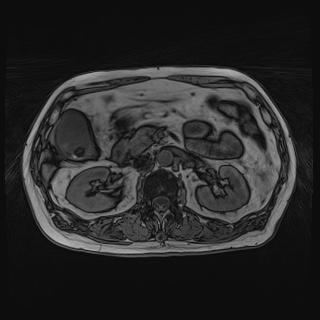 Acute cholecystitis (Radiopaedia 72392-82923 Axial T1 out-of-phase 61).jpg