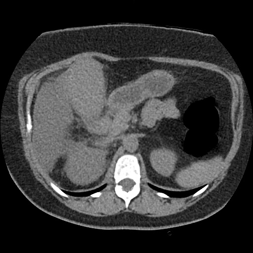 File:Acute cholecystitis and ureteric colic (Radiopaedia 42330-45444 Axial prone 29).jpg