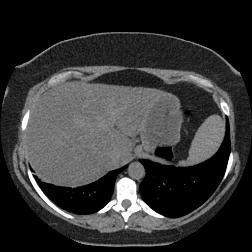 Acute cholecystitis and ureteric colic (Radiopaedia 42330-45444 Axial prone 5).jpg