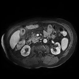 Acute cholecystitis complicated by pylephlebitis (Radiopaedia 65782-74915 Axial arterioportal phase T1 C+ fat sat 84).jpg