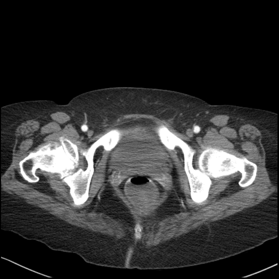 Acute colonic hemorrhage in ulcerative colitis (Radiopaedia 77415-89538 Axial C+ arterial phase 132).jpg