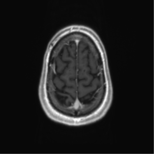 Acute disseminated encephalomyelitis (ADEM) (Radiopaedia 65319-74350 Axial T1 C+ 59).png