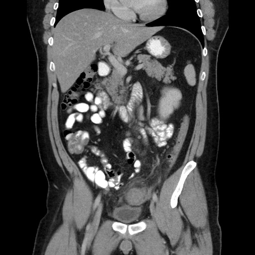 Acute diverticulitis with localized perforation (Radiopaedia 41296-44113 Coronal C+ portal venous phase 30).jpg