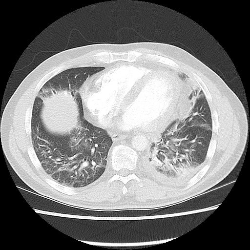 File:Acute epicardial fat necrosis (Radiopaedia 42327-45440 Axial lung window 39).jpg