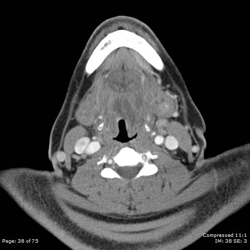 File:Acute epiglottitis (Radiopaedia 54375-60590 Axial C+ arterial phase 38).jpg