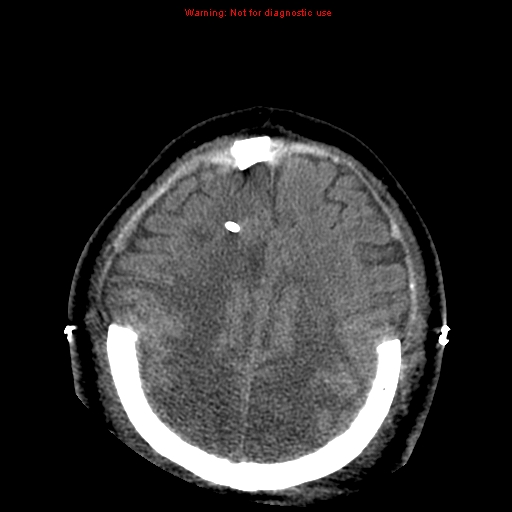 File:Acute hemorrhagic leukoencephalitis (Radiopaedia 14076-43697 Axial non-contrast 38).jpg
