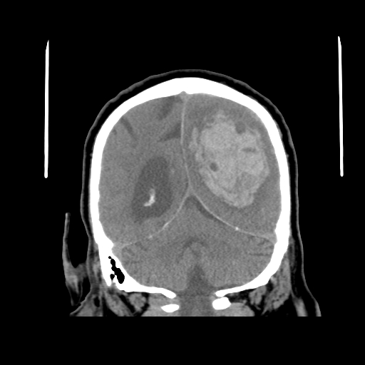 Acute hemorrhagic stroke (Radiopaedia 17507-17223 Coronal non-contrast 39).jpg