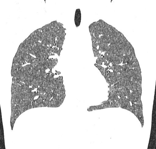Acute hypersensitivity pneumonitis (Radiopaedia 85293-100870 Coronal lung window 58).jpg