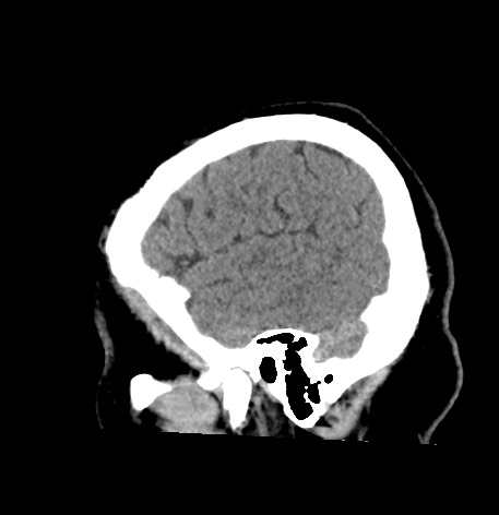 Acute internal carotid artery dissection (Radiopaedia 53541-59558 Sagittal non-contrast 54).jpg