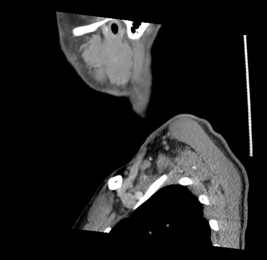 Acute longus colli calcific tendinitis (Radiopaedia 72495-83036 Sagittal C+ arterial phase 2).jpg