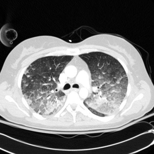 Acute myocardial infarction in CT (Radiopaedia 39947-42415 Axial lung window 45).jpg