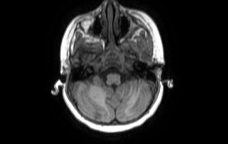 Acute necrotizing encephalitis of childhood (Radiopaedia 67356-76737 Axial T1 78).jpg