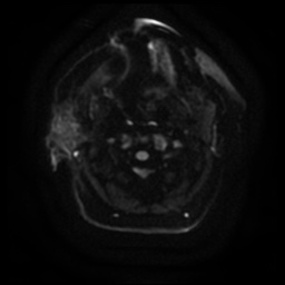 Acute otitis externa (Radiopaedia 57296-64236 Axial DWI 13).jpg