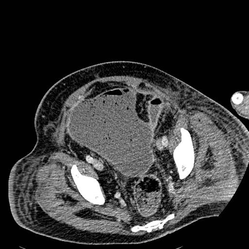 Acute pancreatic necrosis (Radiopaedia 13560-18501 Axial C+ portal venous phase 128).jpg