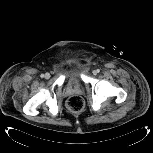 Acute pancreatic necrosis (Radiopaedia 13560-18503 Axial C+ portal venous phase 82).jpg