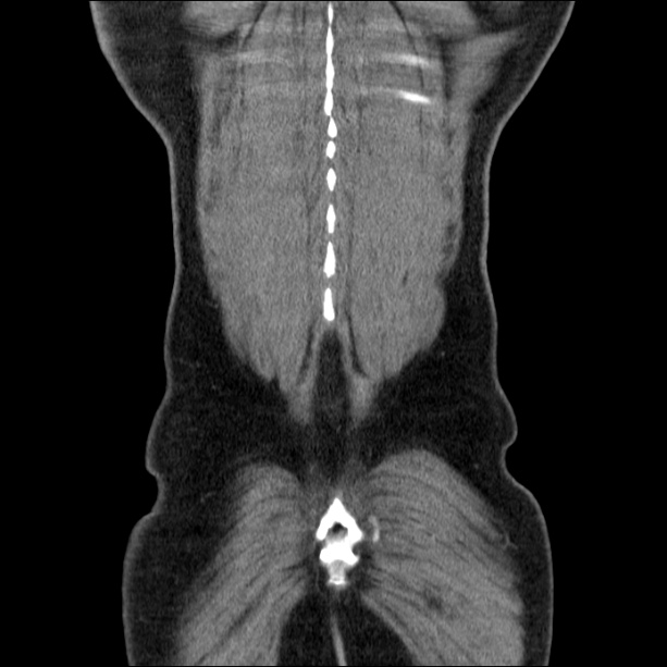 Acute pancreatitis (Radiopaedia 26663-26813 Coronal C+ portal venous phase 59).jpg