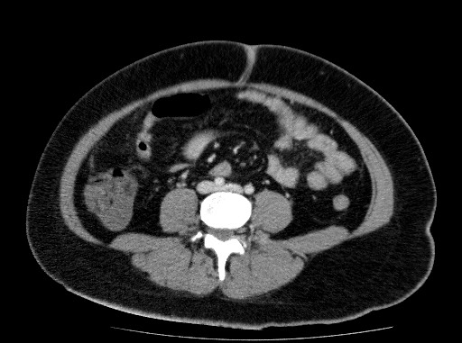 Acute pancreatitis (Radiopaedia 69236-79012 Axial C+ portal venous phase 58).jpg