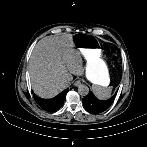 Acute pancreatitis (Radiopaedia 85146-100701 Axial non-contrast 23).jpg