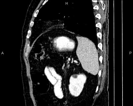 Acute pancreatitis (Radiopaedia 85146-100701 Sagittal C+ portal venous phase 77).jpg