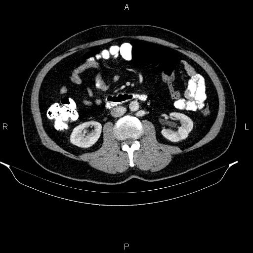 File:Acute pancreatitis (Radiopaedia 85390-101010 Axial C+ portal venous phase 53).jpg