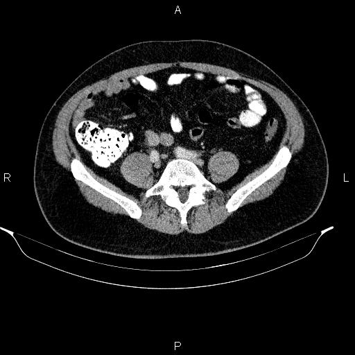 File:Acute pancreatitis (Radiopaedia 85390-101010 Axial C+ portal venous phase 75).jpg