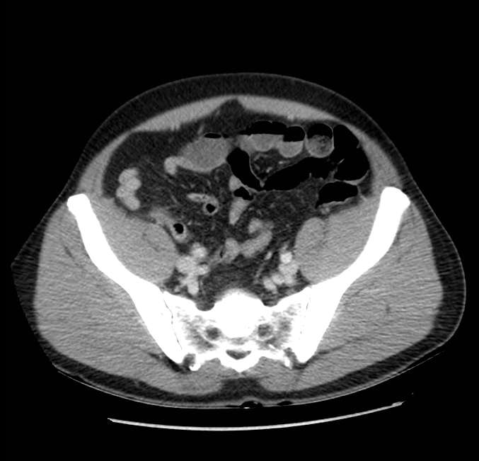 Acute pancreatitis - Balthazar E (Radiopaedia 23080-23110 Axial C+ portal venous phase 57).jpg