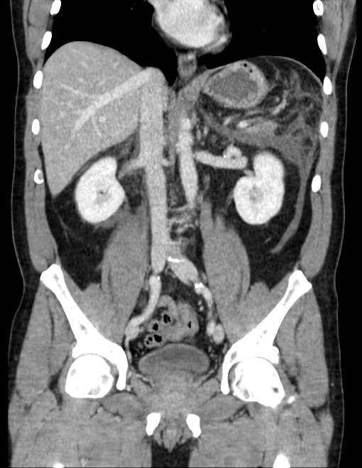 Acute pancreatitis - Balthazar E (Radiopaedia 23080-23110 Coronal C+ portal venous phase 45).jpg
