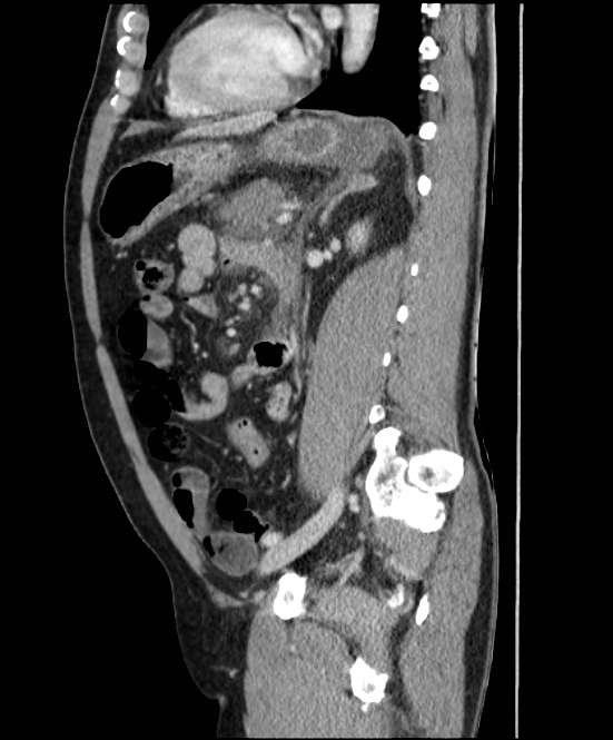 Acute pancreatitis - Balthazar E (Radiopaedia 23080-23110 Sagittal C+ portal venous phase 63).jpg