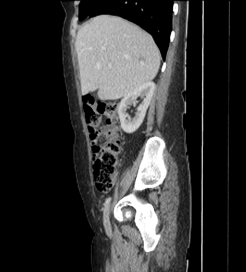 File:Acute pancreatitis - Balthazar E - post ERCP (Radiopaedia 27562-27772 Sagittal C+ portal venous phase 31).png
