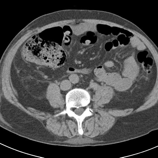 File:Acute pancreatitis and walled-off necrosis (Radiopaedia 29888-30403 Axial non-contrast 45).jpg