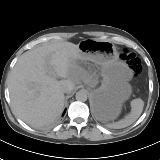 File:Acute pancreatitis and walled-off necrosis (Radiopaedia 29888-30404 Axial non-contrast 15).jpg