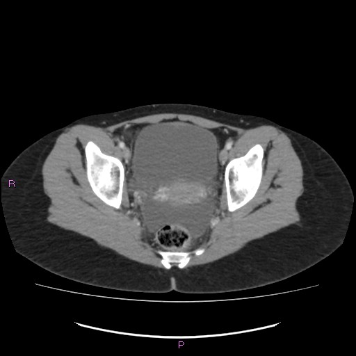 Acute pancreatitis secondary to stone at minor papilla and pancreatic divisum (Radiopaedia 76570-88333 Axial C+ portal venous phase 72).jpg