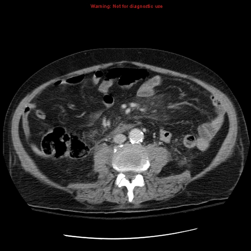 File:Acute pancreatitis with incidental pancreatic lipoma (Radiopaedia 10190-10730 Axial C+ portal venous phase 43).jpg