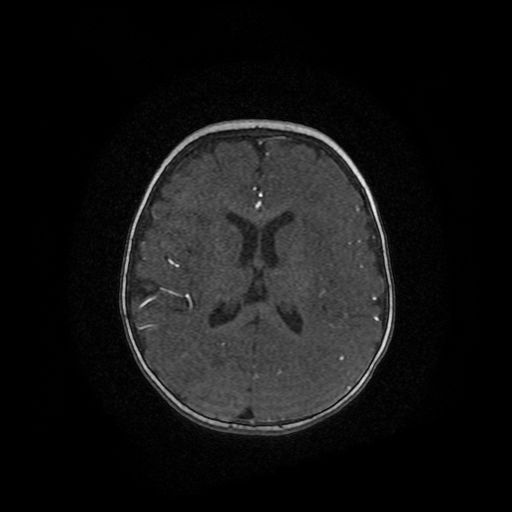 Acute phase of hemiconvulsion-hemiplegia epilepsy syndrome (Radiopaedia 29309-29745 Axial TOF angiography 33).jpg