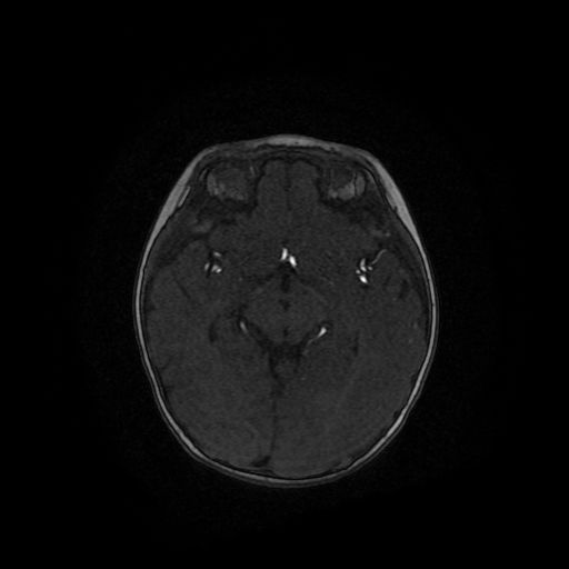 File:Acute phase of hemiconvulsion-hemiplegia epilepsy syndrome (Radiopaedia 29309-29745 Axial TOF angiography 70).jpg