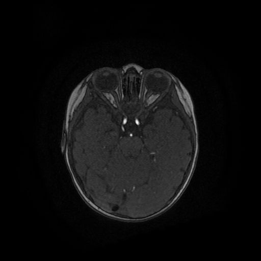 Acute phase of hemiconvulsion-hemiplegia epilepsy syndrome (Radiopaedia 29309-29745 Axial TOF angiography 92).jpg
