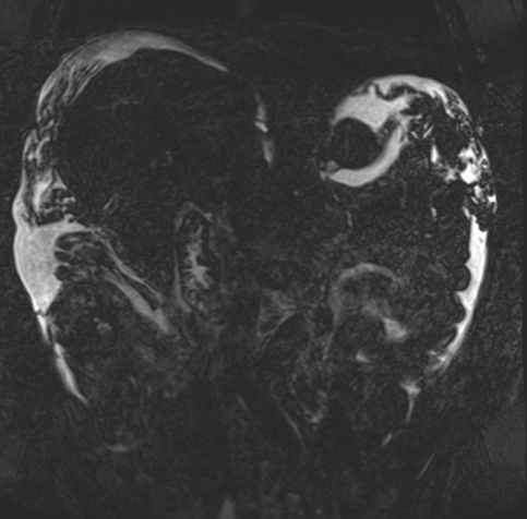 Acute portal vein thrombosis (Radiopaedia 73198-83925 Coronal Heavily T2 thin cuts 45).jpg