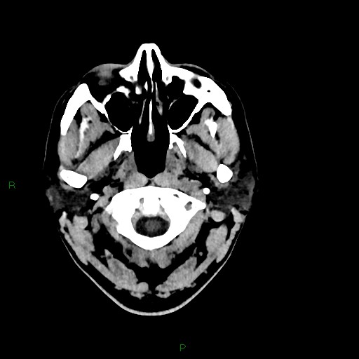 File:Acute posterior cerebral artery territory infarct (Radiopaedia 79329-92393 Axial non-contrast 3).jpg